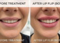 lip flip before and after