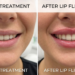 lip flip before and after