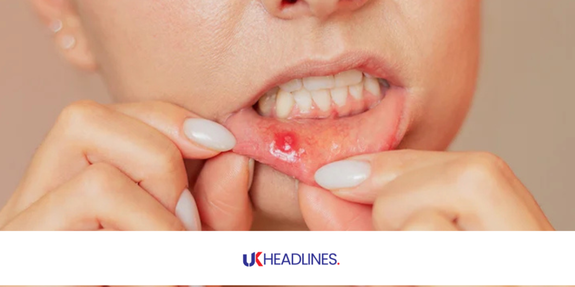 how to get rid of a canker sore in 24 hours