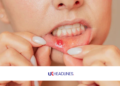 how to get rid of a canker sore in 24 hours