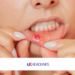 how to get rid of a canker sore in 24 hours