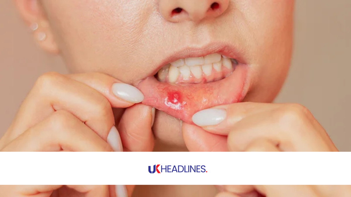 how to get rid of a canker sore in 24 hours
