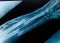 What Is the Broken Bone Theory