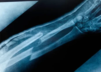 What Is the Broken Bone Theory