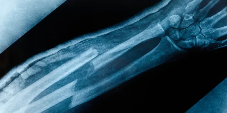 What Is the Broken Bone Theory