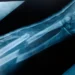 What Is the Broken Bone Theory