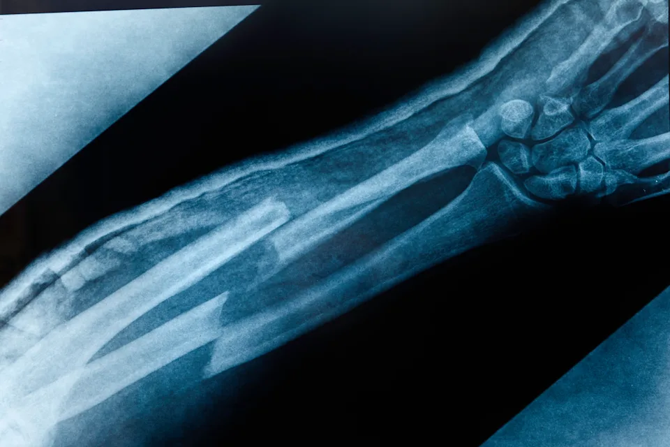 What Is the Broken Bone Theory