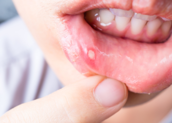 how to get rid of a canker sore in 24 hours