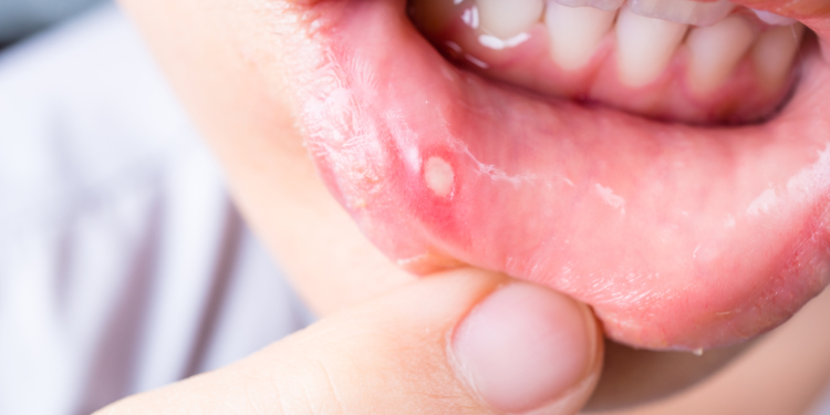 how to get rid of a canker sore in 24 hours
