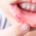how to get rid of a canker sore in 24 hours