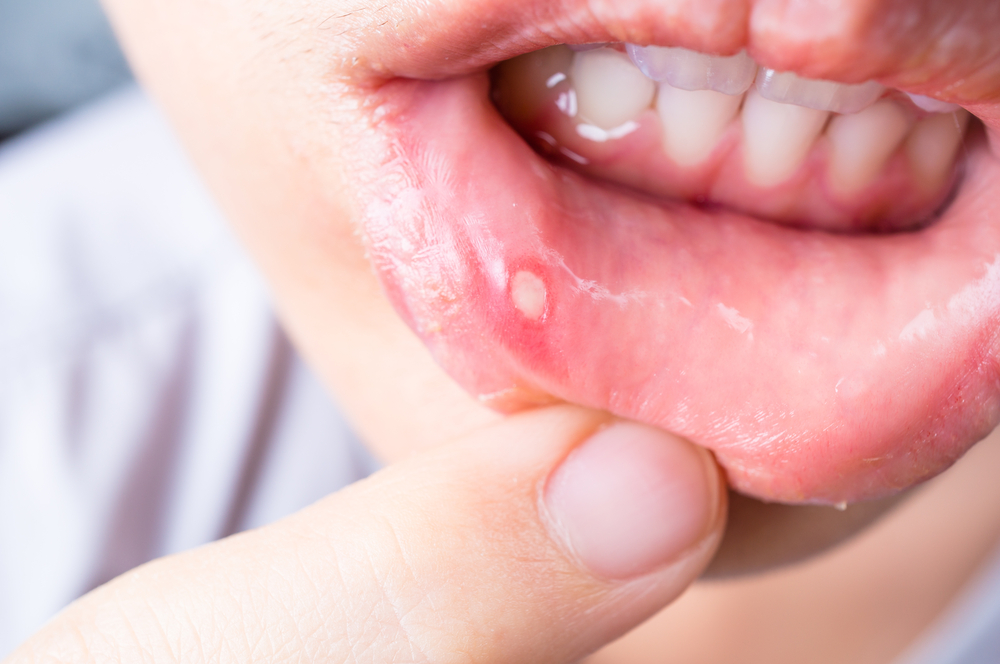 how to get rid of a canker sore in 24 hours