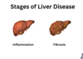 what are the 4 stages of cirrhosis of the liver?