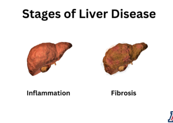 what are the 4 stages of cirrhosis of the liver?