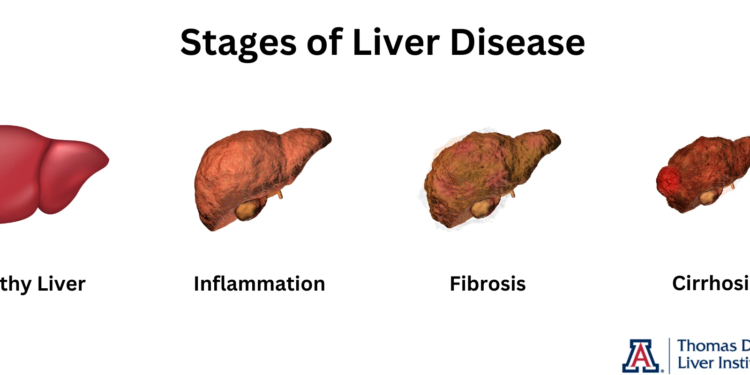 what are the 4 stages of cirrhosis of the liver?