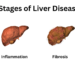 what are the 4 stages of cirrhosis of the liver?