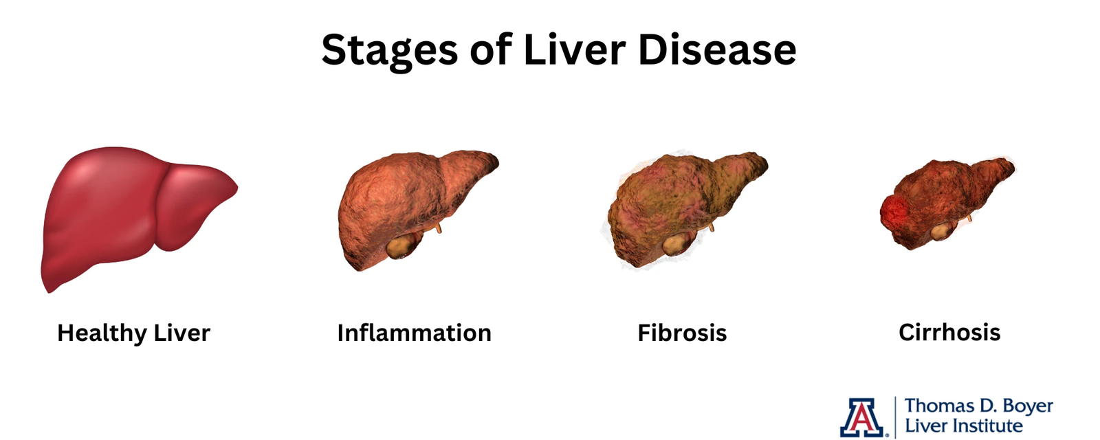 what are the 4 stages of cirrhosis of the liver?