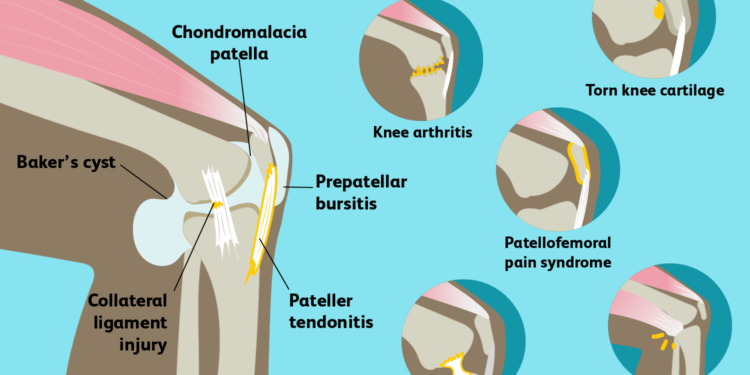 my knee hurts when i bend it and straighten it but no swelling