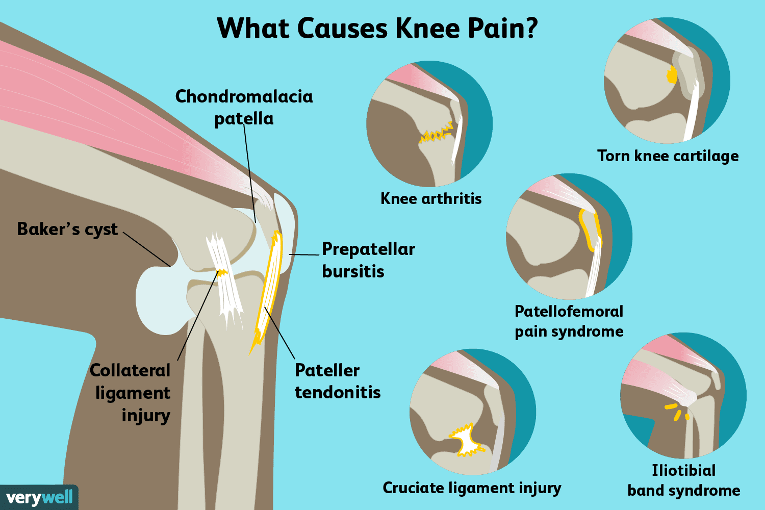 my knee hurts when i bend it and straighten it but no swelling