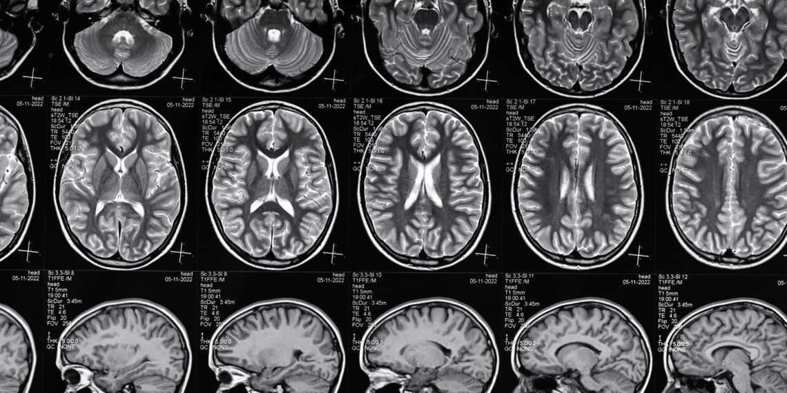 Understanding Brain Injury Claims: Your Legal Rights After a Serious Accident 