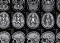 Understanding Brain Injury Claims: Your Legal Rights After a Serious Accident 