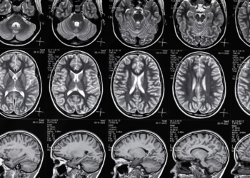 Understanding Brain Injury Claims: Your Legal Rights After a Serious Accident 