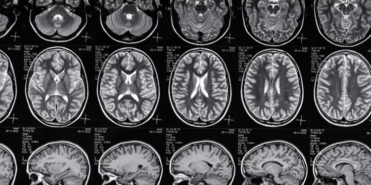 Understanding Brain Injury Claims: Your Legal Rights After a Serious Accident 