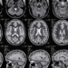 Understanding Brain Injury Claims: Your Legal Rights After a Serious Accident