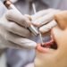 Why Your NHS Dentist Keeps Recommending ‘Private Extras’: What’s Actually Optional vs Medically Necessary in Southwell