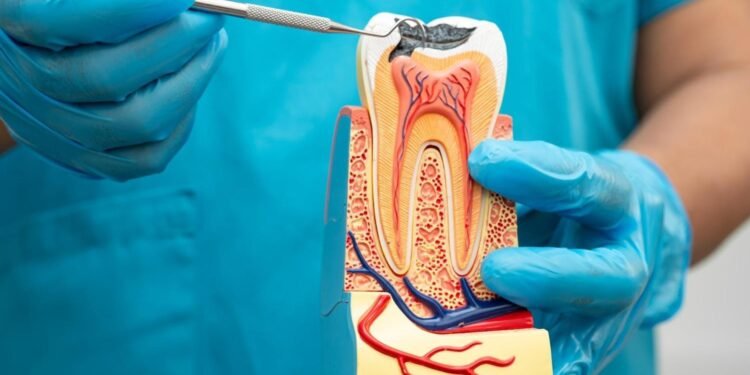 Root Canal
