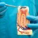 Root Canal
