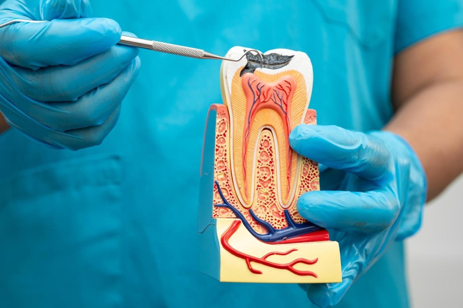 Root Canal